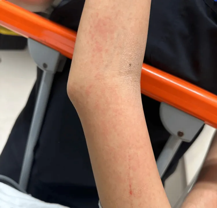 登革热皮疹