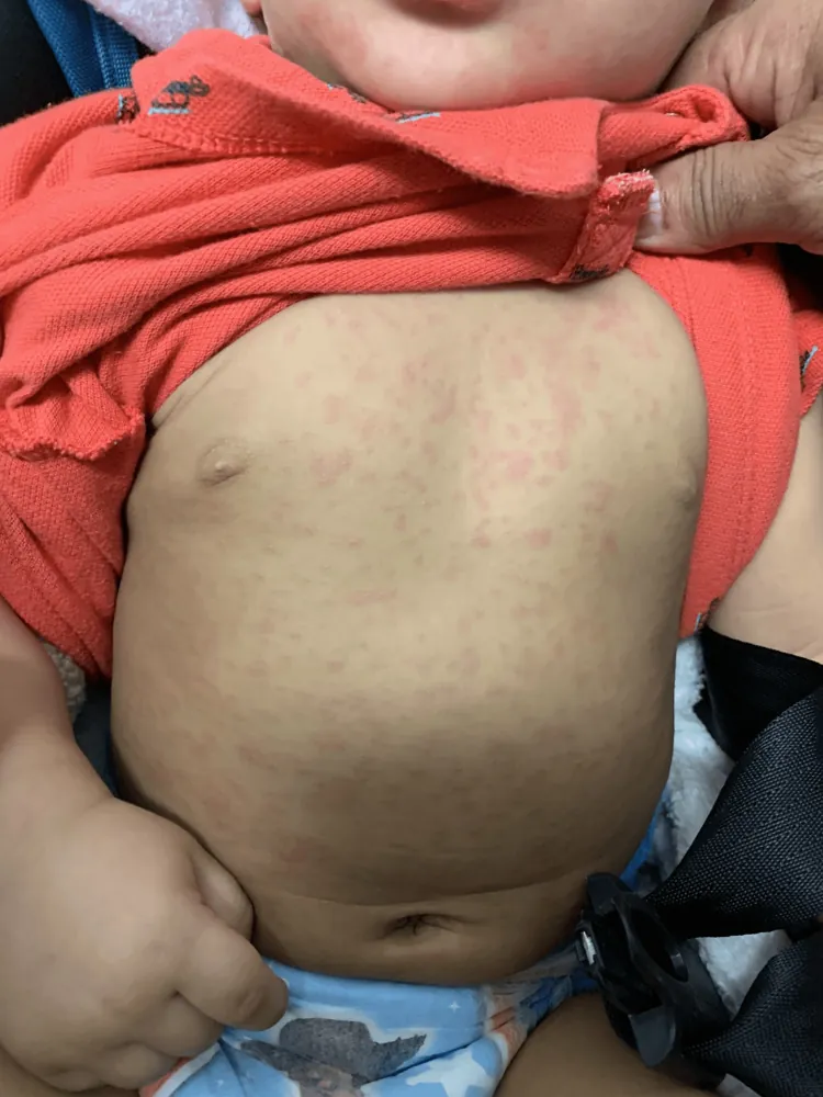 幼儿急疹皮疹